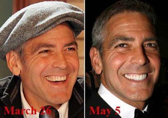 celebrity teeth fake celebrities before clooney george smile dental stars veneers famous smiles hollywood makeover celebs surgery dentures implants plastic